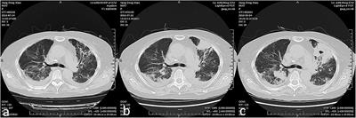 Acute Exacerbation of Interstitial Lung Disease in Adult Patients With Idiopathic Inflammatory Myopathies: A Retrospective Case-Control Study